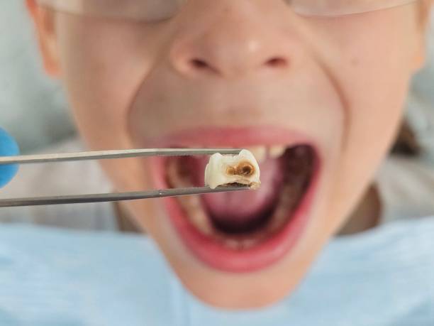 Best Emergency Root Canal Treatment in Kalifornsky, AK